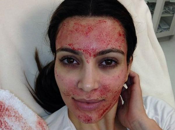 SibanaLaser's tweet photo. El tratamiento del vampiro de Kim Kardashian para restar años a su piel, esta solo en #Sibana #Maracaibo http://t.co/RHBpRRv6uN