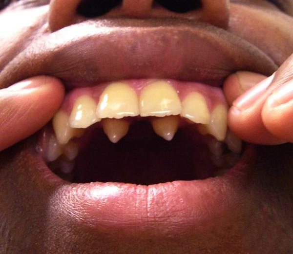 Suarez dent Barcelone