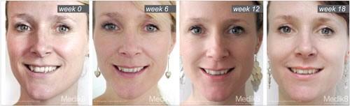 radiofrequency3's tweet photo. The derma roller very popular at the minute I am doing a offer for the next 2weeks starting Monday for £75 treatment😷 http://t.co/8WBNn8U4hX