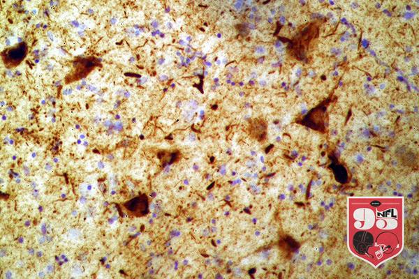 theMMQB's tweet photo. #NFL95: Tau Protein, which is linked to causing CTE: http://t.co/GNCsfgKjMD http://t.co/5pZ3Ylsvmp