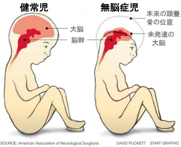 ポーラスター Na Twitterze 広島 長崎 イラク チェルノブイリ 福島県では 被曝の影響で無脳症などの奇形児が多く産まれています ケネディ大使と米大使館に日米原子力協定の破棄と 日本からの米軍基地撤退を要求します Http T Co Zvvsokmto4 Rt M Kiko B