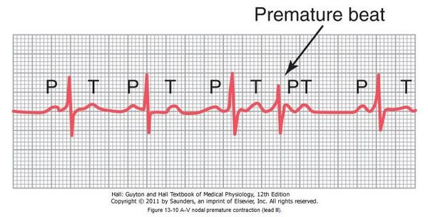 Symcard2014's tweet photo. Kontraksi prematur nodus/berkas AV: gel P hilang, gel P bergabung(superimposed) dg QRS #symcardBeli10Gratis1 http://t.co/pwYqBY2C5k