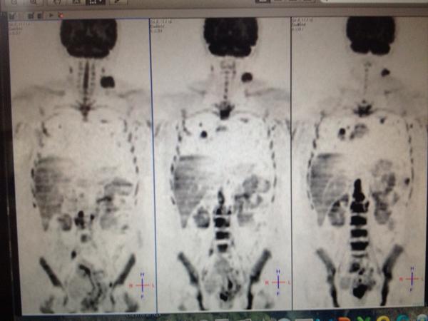 RMCarema's tweet photo. #PETVIRTUAL gran adenomegalia en cuello sin origen(metástasis de origen desconocido) se ve una masa en pulmón http://t.co/YLrB1pBNYa