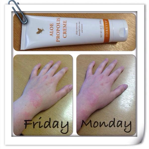 aloe propolis creme eczema