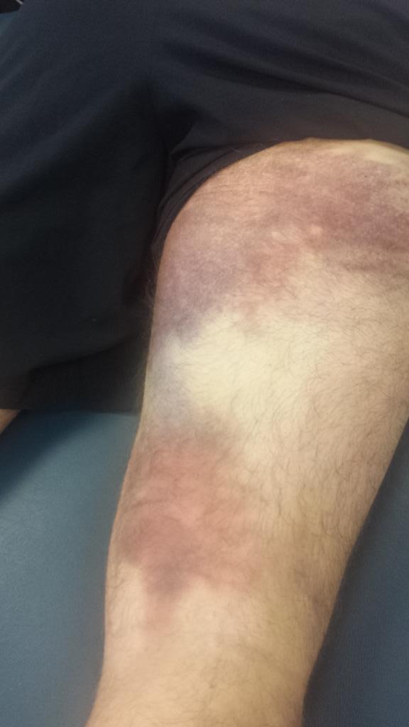 3pk's tweet image. One treatment #LiteCureLaser and look at the difference lymph tape job  for #HamstringPull #FastRecovery