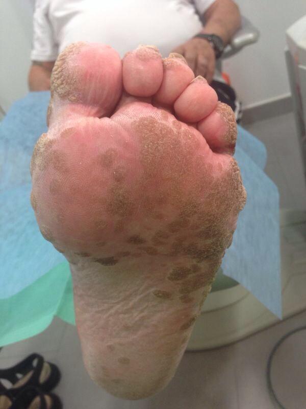 tuclinicadelpie's tweet photo. Papilomatosis en paciente con VIH http://t.co/Ihkln5aECV