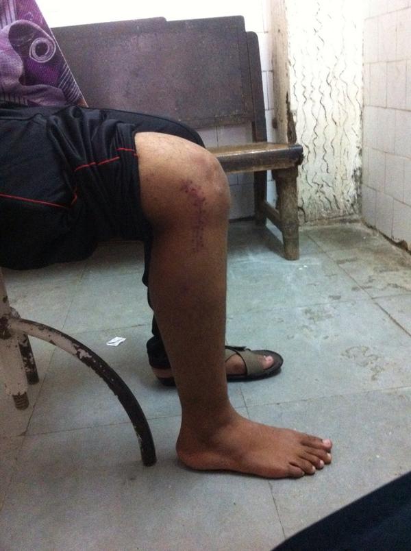 Aashhosp's tweet photo. Knee injury. Do not walk with an unstable knee. If required get multiple ligaments reconstructed to prevent arthritis http://t.co/lpe3Gw60Nu