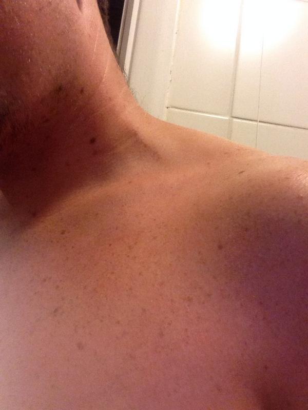 Kinchin86's tweet image. Attacked myself in my sleep! #wtf #scratchmarks