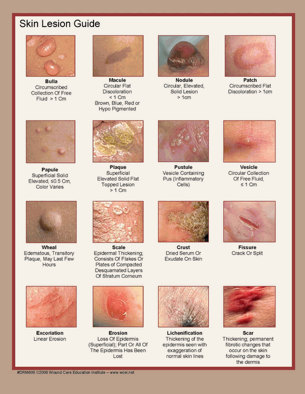 Skin Lesions Descriptions Pictures Photos