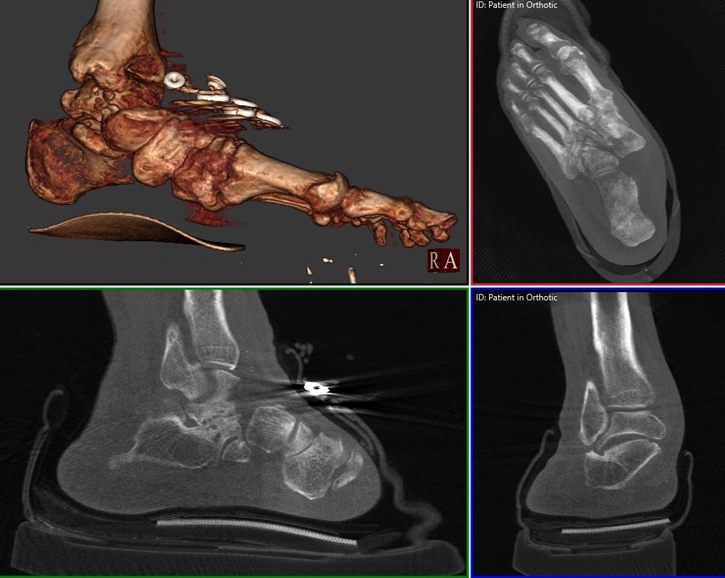 CurveBeam AI в Twitter: „pedCAT weight bearing CT scan of a flat foot  patient wearing his orthotic. Are you offering your patients the best?  http://t.co/Zv103kIYR0“ / Twitter