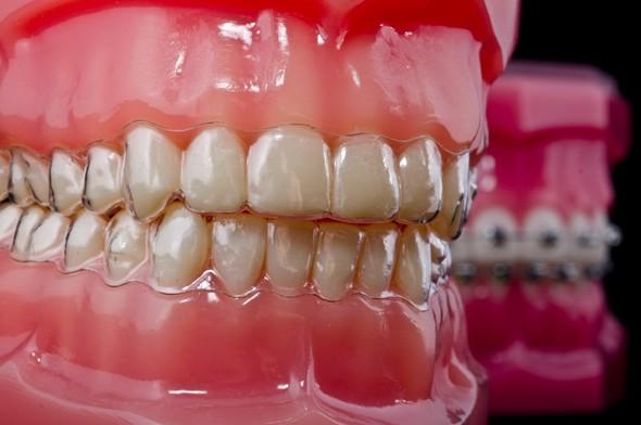 drsamtabban's tweet photo. Close view Invisalign Typodont Vs Metal Braces Typodont #invisalign #invisalife #invisaligngcc http://t.co/BUnsESBR9n