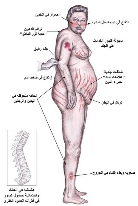 الكورتيزول اعراض ارتفاع أسباب ارتفاع