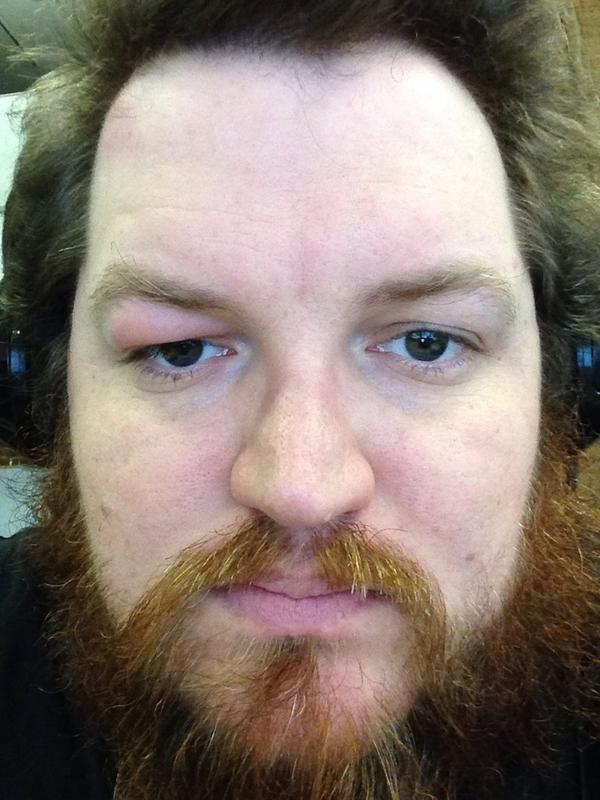 edcasey's tweet image. DEVELOPMENT! Eye is just a tiny bit swollen. 

It's been really nice knowing you guys. I'll miss most of you. #RIPEd