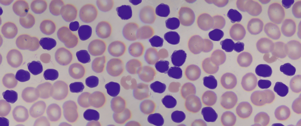 FDA_Drug_Info's tweet image. FDA approves Zydelig for three types of blood cancers. go.usa.gov/5US5