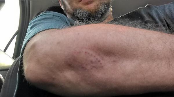 watupdanks's tweet photo. Line drive off my forearm. Check out the laces from the ball. http://t.co/pf3iDybgx0