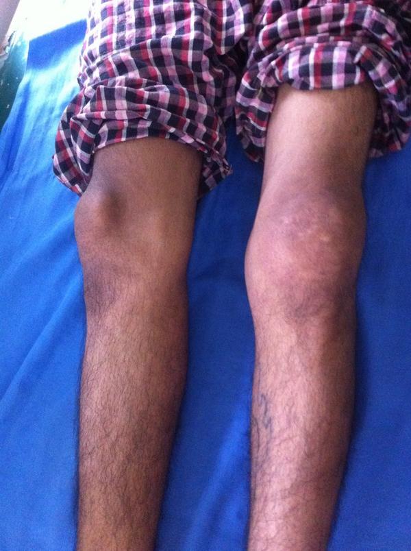 Aashhosp's tweet photo. Undiagnosed recurrent knee swelling for 3 yrs. in a 20 yes man. Obvious diagnosis- neglected ligament (PCL) injury http://t.co/f0VB5eqQTm