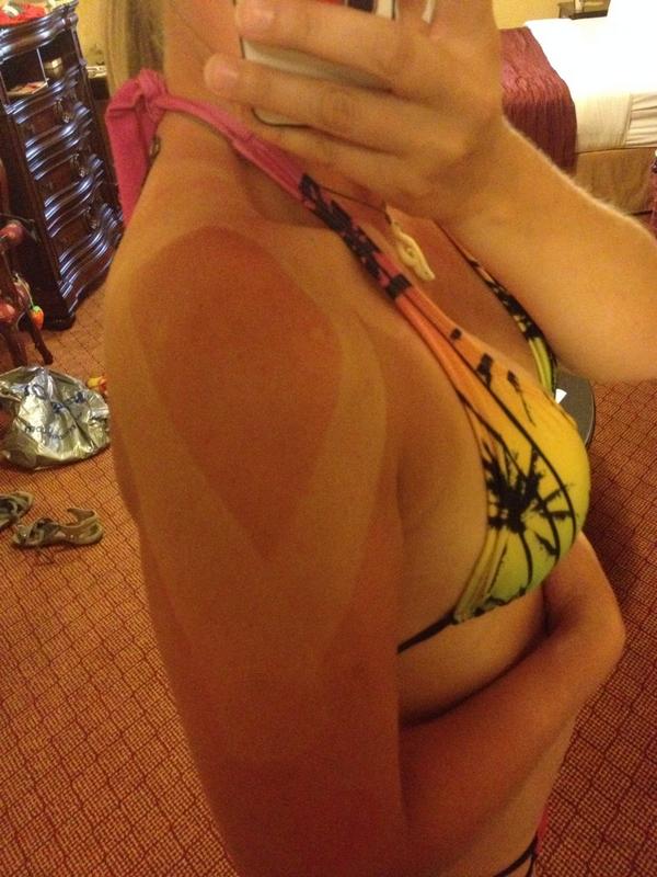 JeMauger's tweet photo. @CrossFitGames check out my awesome post games @Rocktape tan lines. Thanks Dr Steve for all the help! http://t.co/VfirEPOs3a