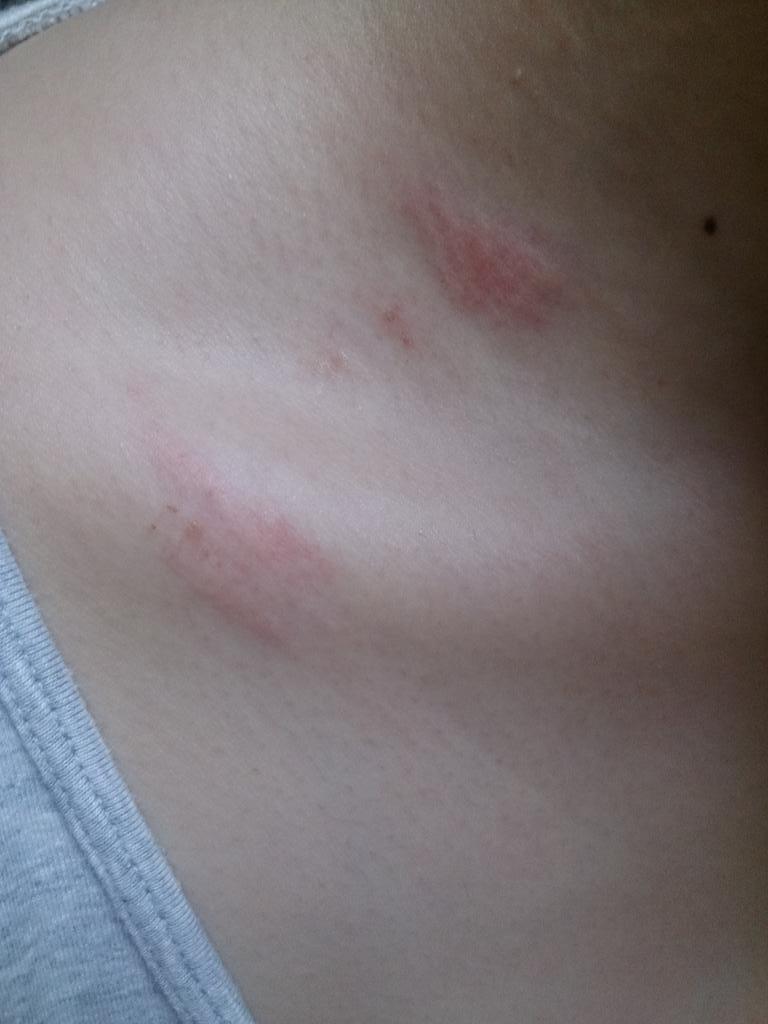 ぱん on X: 虫刺されがキスマークにしか見えないと言われる。すげー痒いんだぞ(´；ω；｀)つかほんとに虫刺されなのか？(´；ω；｀)  http:t.cowSN05pLEiS  X