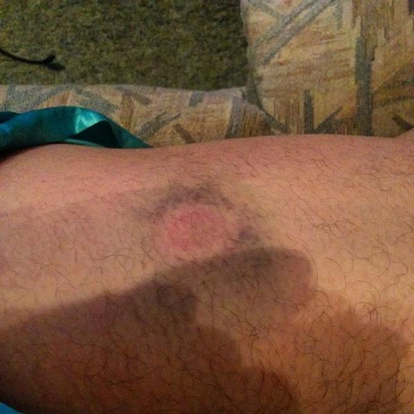 GotchaNayarit's tweet image. Decent bruise from paintball sat night #paintball #sickfun #adrenaline #nofilters