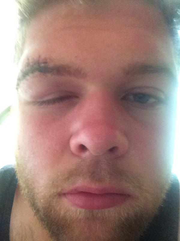 Stitches feeling a little better today!