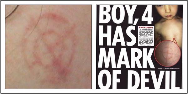bengoldacre's tweet image. I hope GP/Sun have assessed for non accidental injury RT @Unnamedinsider: 'Mark of Devil’ same as this hairdryer burn