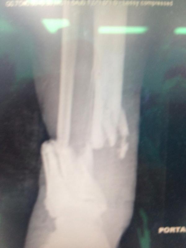 orthosak's tweet photo. Open 3C distal tibia with artery forceps on distal vessel http://t.co/t0vlGAtUfs