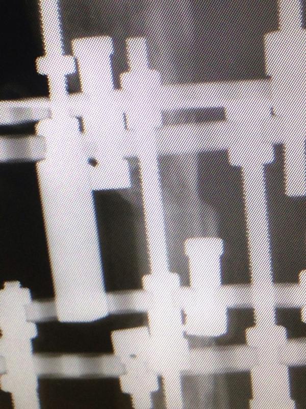 orthosak's tweet photo. 9 mnth in frame for bone transport . Frame removed 2 weeks ago after 1 mnth dynamisation. Heard a crack fracture!! http://t.co/ikDfXscyHe
