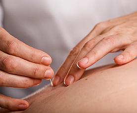 HarveyAoife's tweet image. #DryNeedling is a great treatment technique I use daily in my clinic for #SportsInjuries &amp;amp; #SpinalPathologies.