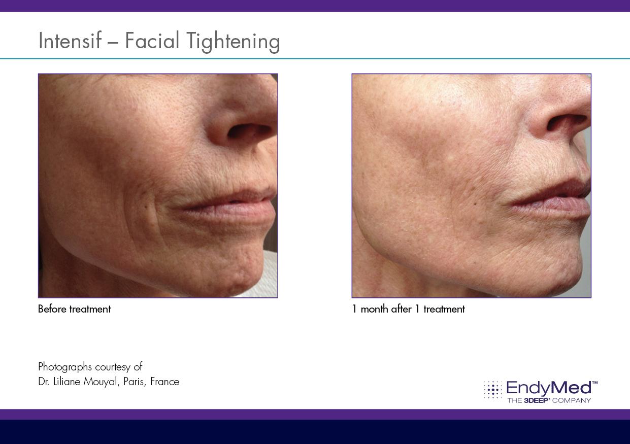 endymed intensif