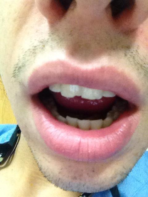 Be N On Twitter Stopped Wearing My Retainer And Chipped My Tooth Starting To Actually Look Like I Grew Up In Bedford Http T Co Eslhmevtl9