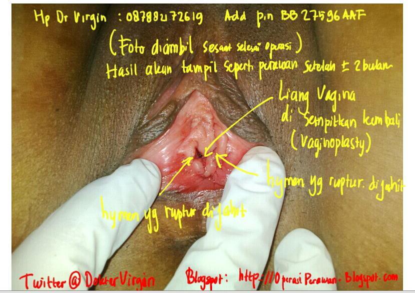 Dokter Virgin On Twitter Ini Perbedaan Antara Hymen Y