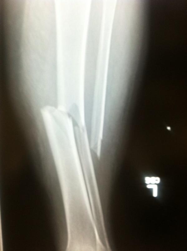 Tibia And Fibula Paul George