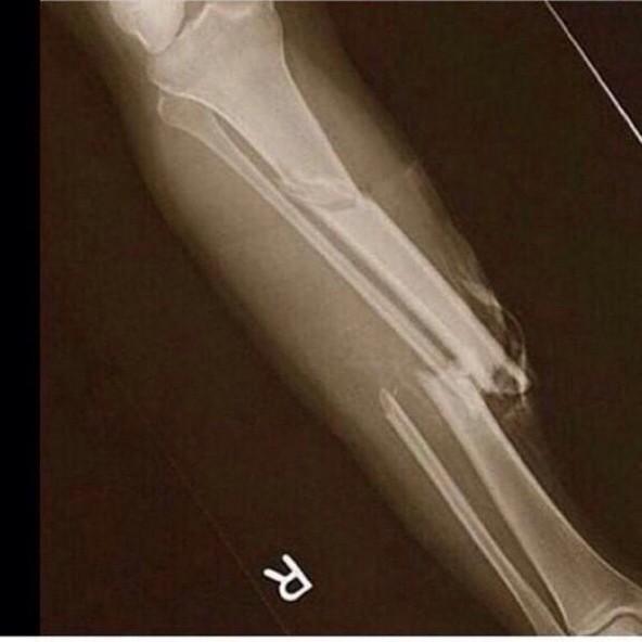 DoctorNBA's tweet photo. Paul George's X-rays http://t.co/DO1jKSI4zQ