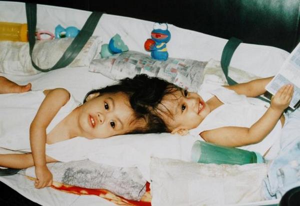 MSNNews's tweet image. 10 years later, once-conjoined twins have separate lives on-msn.com/1tK0BGC