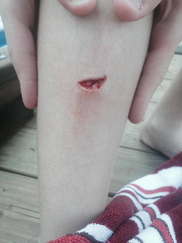 Rebirth_tK's tweet image. Cut My Leg On The Trolling Plate Of My Dads Boat. While I Was Coming Up The Ladder.