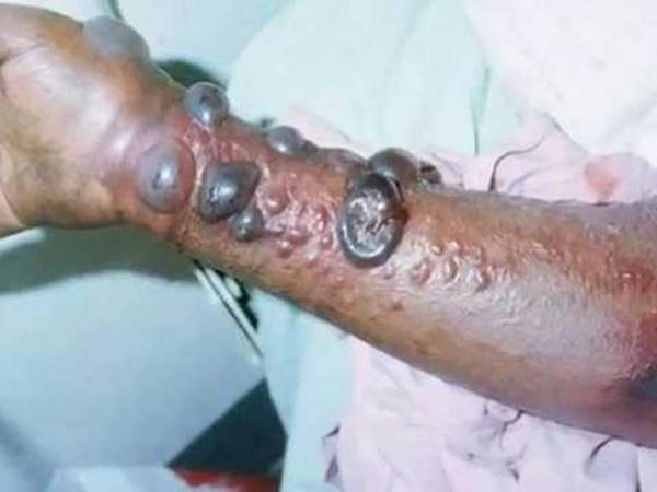 diarioelheraldo's tweet photo. OMS alerta sobre llegada del virus del Ébola al continente americano http://t.co/OOEsRHpHaP http://t.co/jX9njixTWA