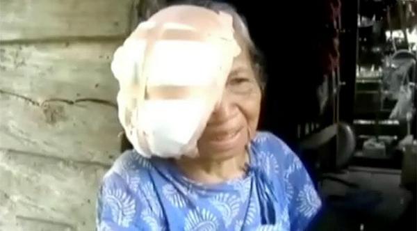 Kepala Seorang Nenek di Polewali Mandar Digerogoti Belatung bit.ly/1oCn58O