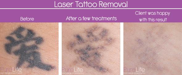 PureLiteKent's tweet photo. LASER TATTOO REMOVAL RESULTS!!

http://t.co/3hr2PYruLW http://t.co/PEPW6RiNTy