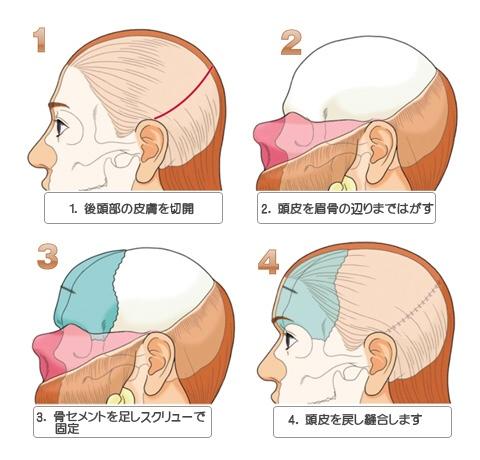 あお V Tvittere もう美容整形じゃねーよ 人体改造の域だよ なにをサラッと 頭皮を眉骨の辺りまで剥がす だよ 外人のおでこ憧れるけど剥がす勇気はないよ Http T Co Uts9yrxyxx
