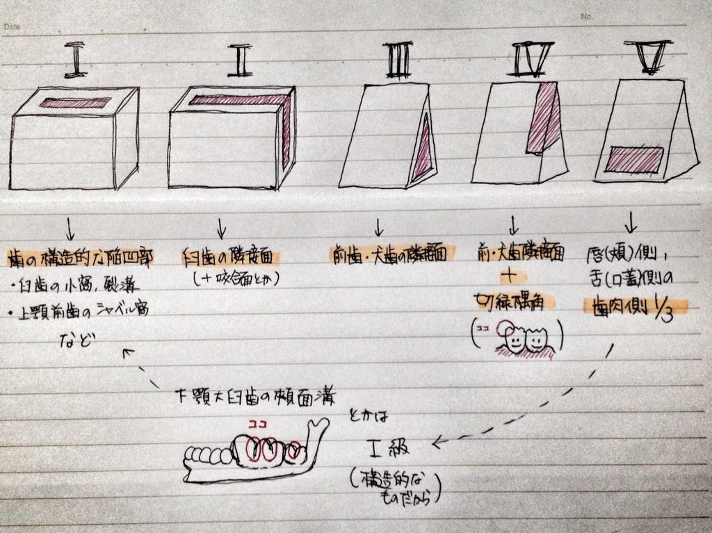 歯科衛生士の座学 毎日更新 重要度 覚えてて当たり前 いい加減覚えたい Blackの窩洞の分類 Http T Co Twtq9oxlvu