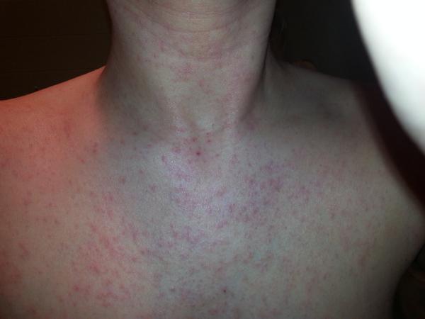 overwhelmed's tweet photo. enough...#Allergy #Medical #Mystery http://t.co/177gajmFQW
