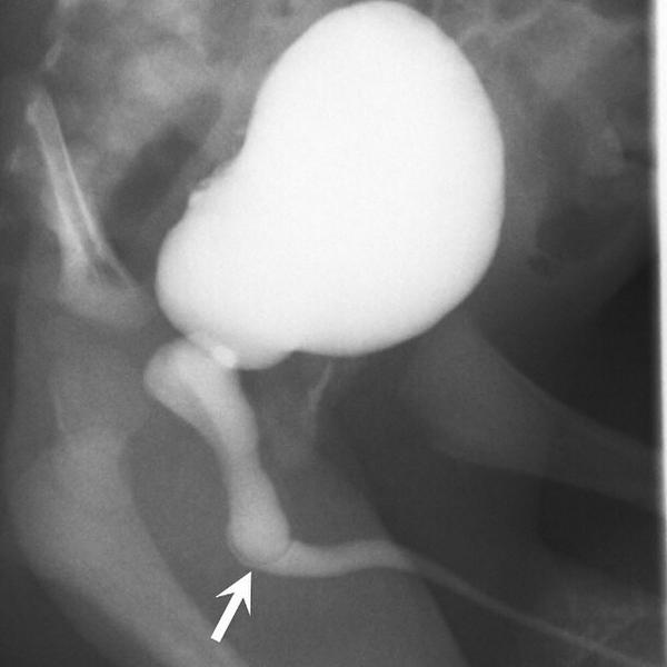 CincyKidsRad's tweet image. Lateral image from a #voiding #cystourethrogram shows a dilated posterior urethra. There is a curvilinear lucency...