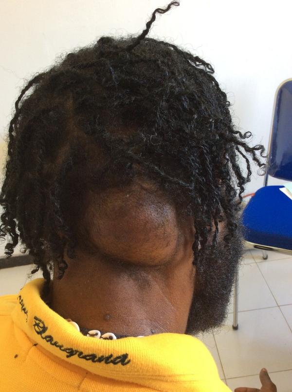 soalUKDI's tweet photo. 4. kenyal, permukaan rata, batas tegas, mobile, tdk nyeri. dialami sejak 6th yl. Diagnosis? http://t.co/GuXWlm9xaR