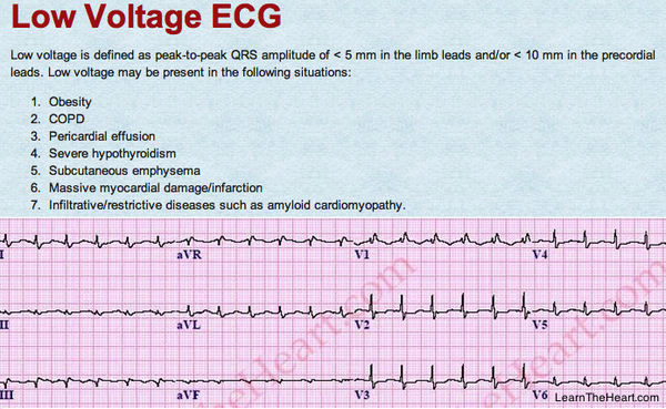 Low voltage #ECG

Know criteria and at least 7 causes

#USMLE
