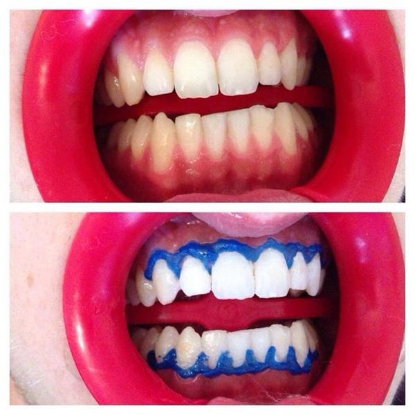 bedazzledhandb's tweet photo. 10 shades whiter with our non peroxide teeth whitening 😬😬😬 http://t.co/iEC3mmhUDy