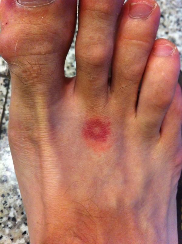 A nice Spanish souvenir in the form of a bloody itching mosquito bite!