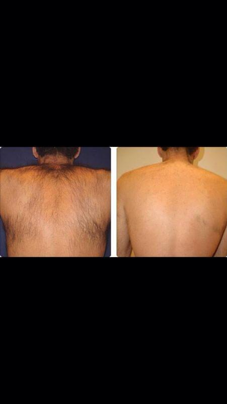 Before&After...#laser #back #man #laserhairemoval #sopranoIce #Almalasers #pretoria #beforeandafter #painfreehairfree