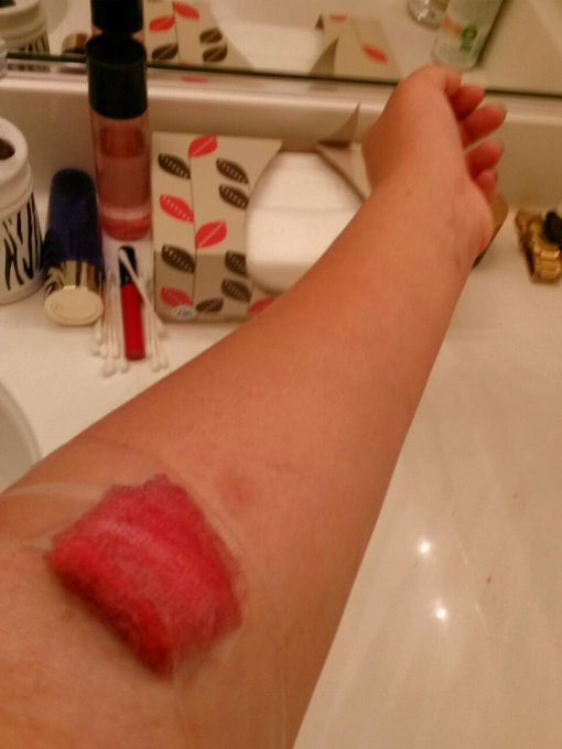 Good job Henry mayo hospital. Best IV removal ever  #IdiotsEverywhere http://t.co/lOkPxXQT0w<a href="/tag/idiotseverywhere"class="tags"><span>#idiotseverywhere</span></a>