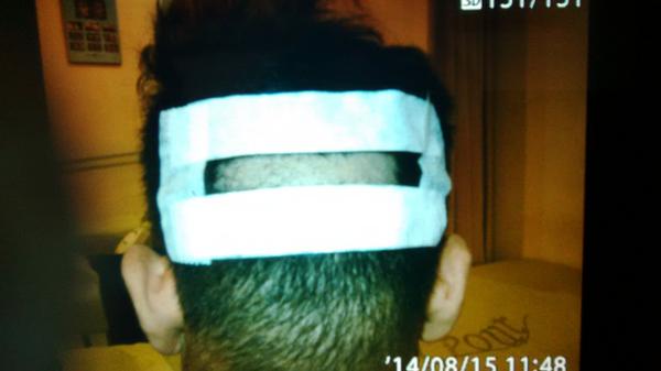 md_dee's tweet image. Persiapan Area Donor.. #Hairtransplantjakarta