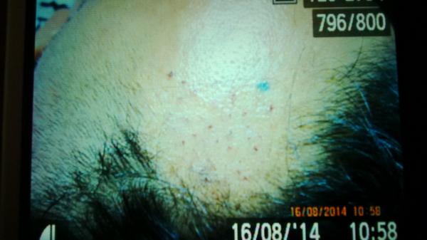 md_dee's tweet image. Luka sudah kering, dan rambut yg baru di tanam terlihat intact dengan baik.. Good job..!! #Hairtransplantjakarta